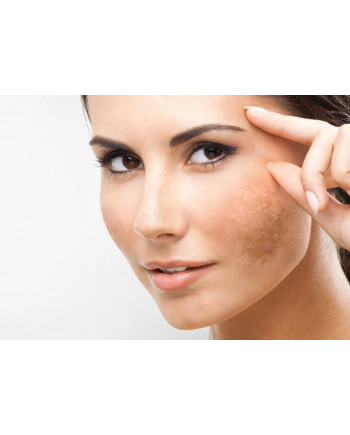 What is Melasma? What is Melasma?