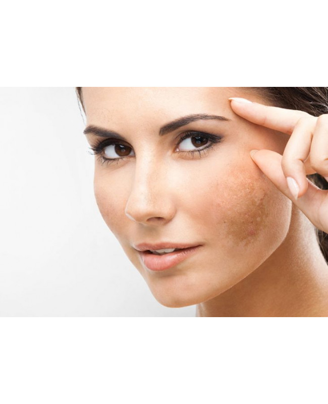 What is Melasma?